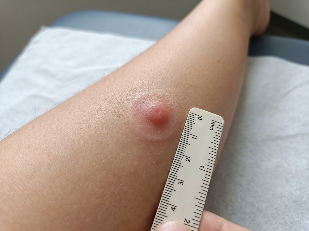 Close-up photograph of a fresh red welt from a paper wasp sting on skin with mild surrounding redness